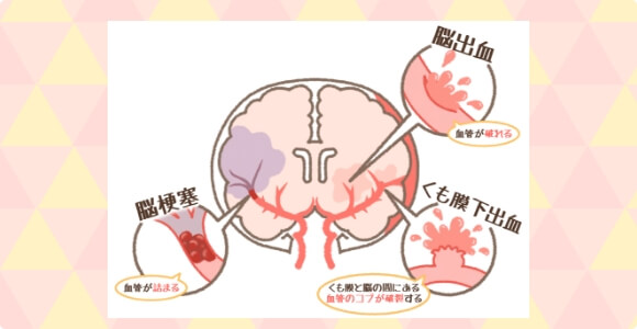 脳卒中とは
